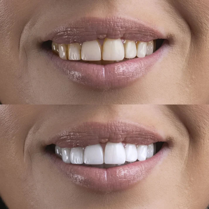 PlaqueLifter Ultrasonic Tooth Cleaner